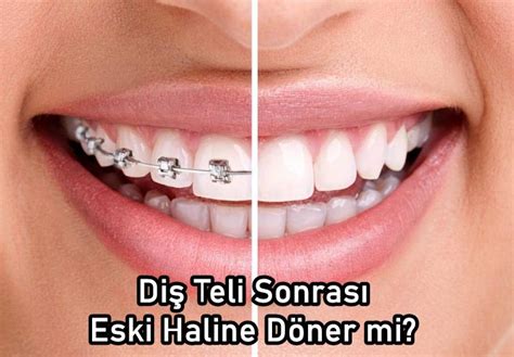 Çapraşık Dişler İçin Diş Teli Kullanımı