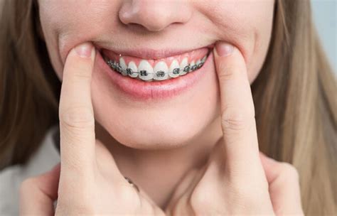 Diş Teli Tedavi Süresi Nasıl Belirlenir?