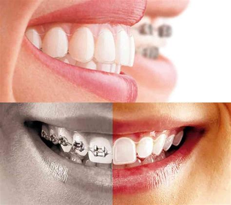 Diş Teli Tedavisi Sonrası Uygulanan Retainerlar