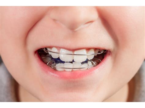Diş Teli Tedavisinde Ağrı ve Rahatlama Yöntemleri