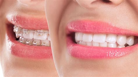 Diş Teli Tedavisinde Genel Yan Etkiler
