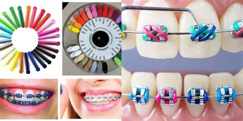 Diş Teli Tedavisinde Renk Seçenekleri ve Modelleri