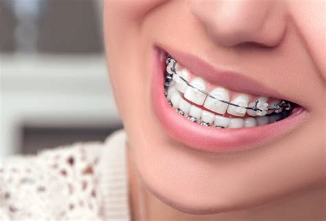 Hangi Durumlarda Diş Teli Takmak Gerekir?