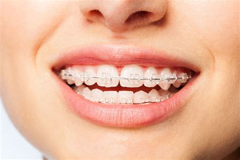 Şeffaf Diş Teli ile Tedavi Süreci